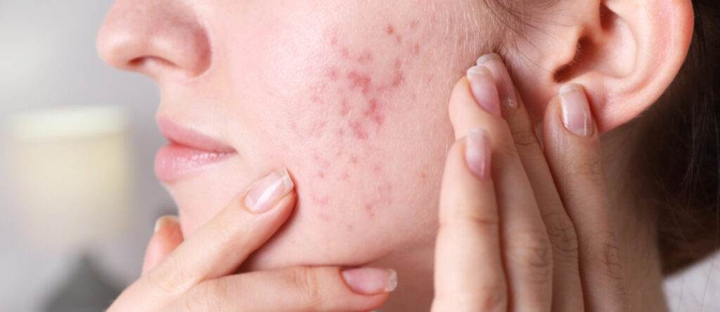 acne santagostino rho