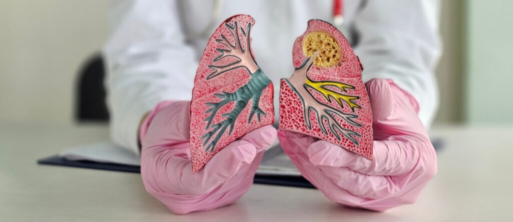 bronchite santagostino rho