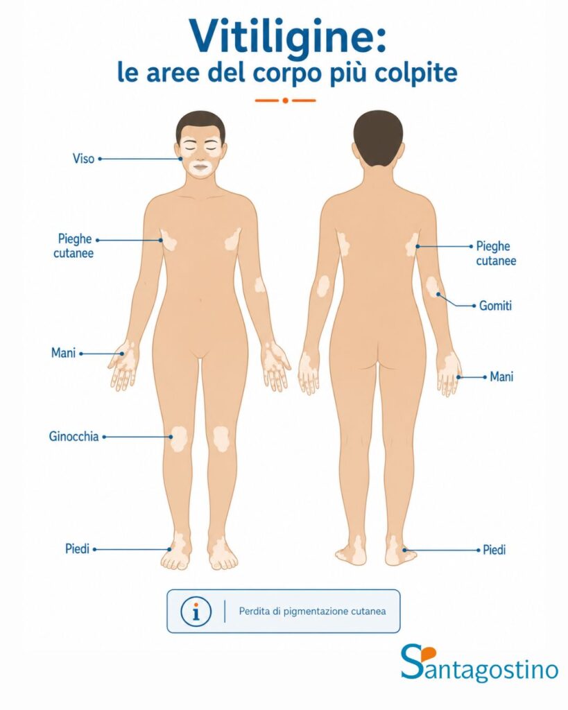 vitiligine aree colpite