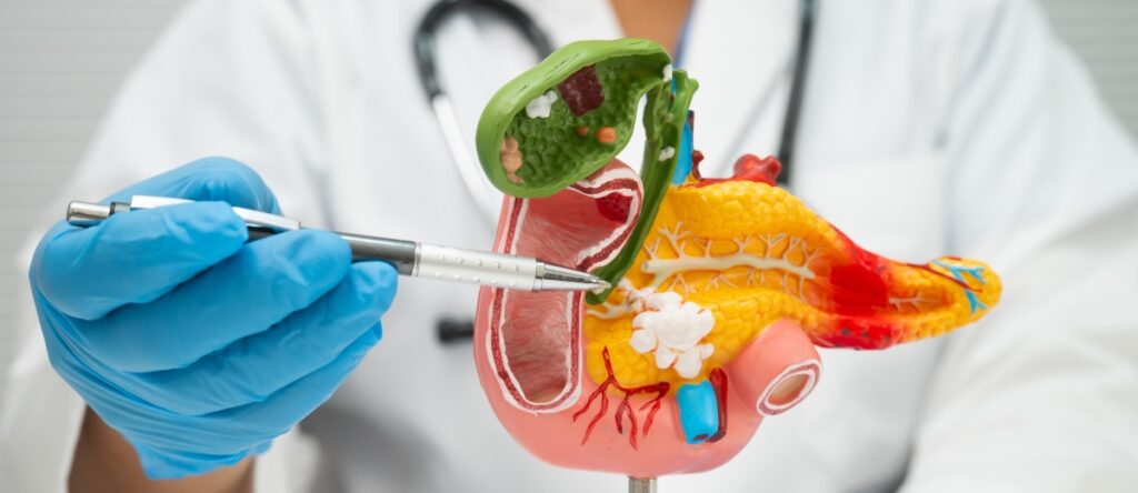 pancreatite acuta