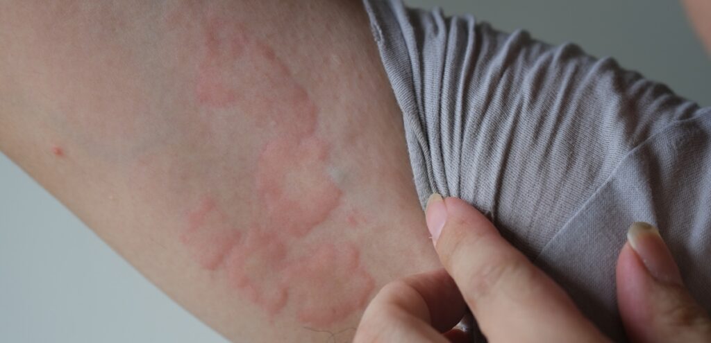 orticaria santagostino rho