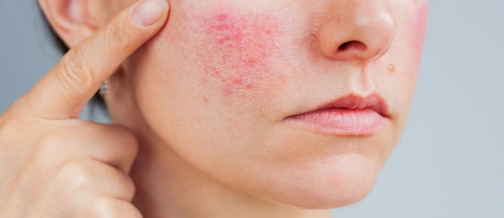 rosacea rho